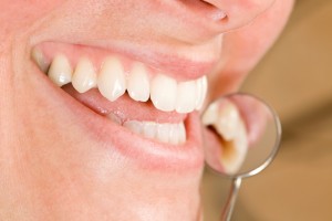 teeth whitening spring lake