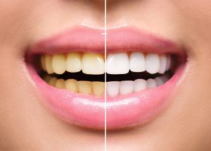side-by-side comparison of yellow smile before and after Spring Lake dentist