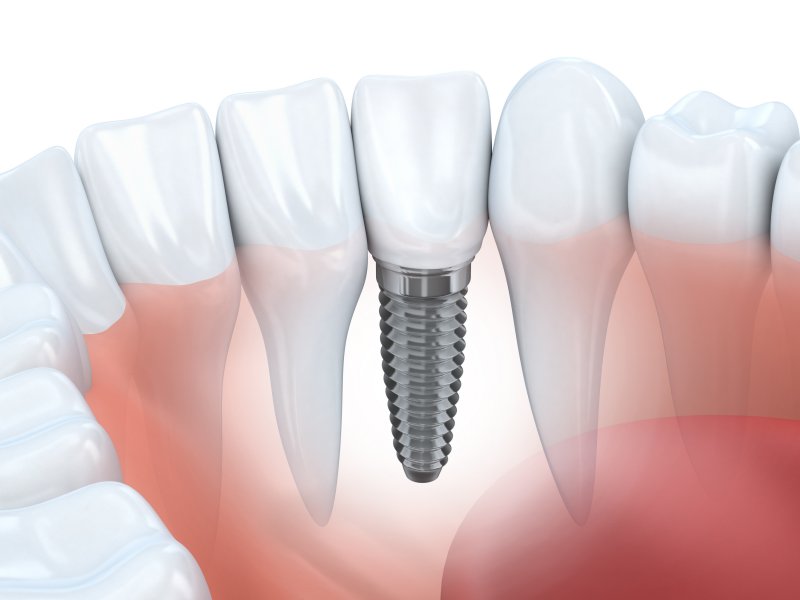 3D model of a dental implant