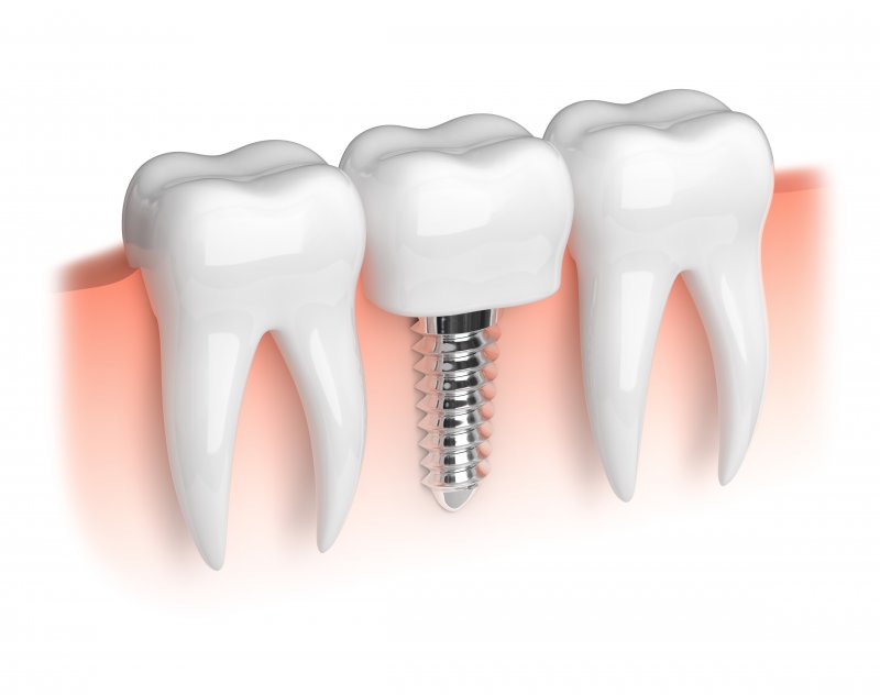 3D model of dental implant